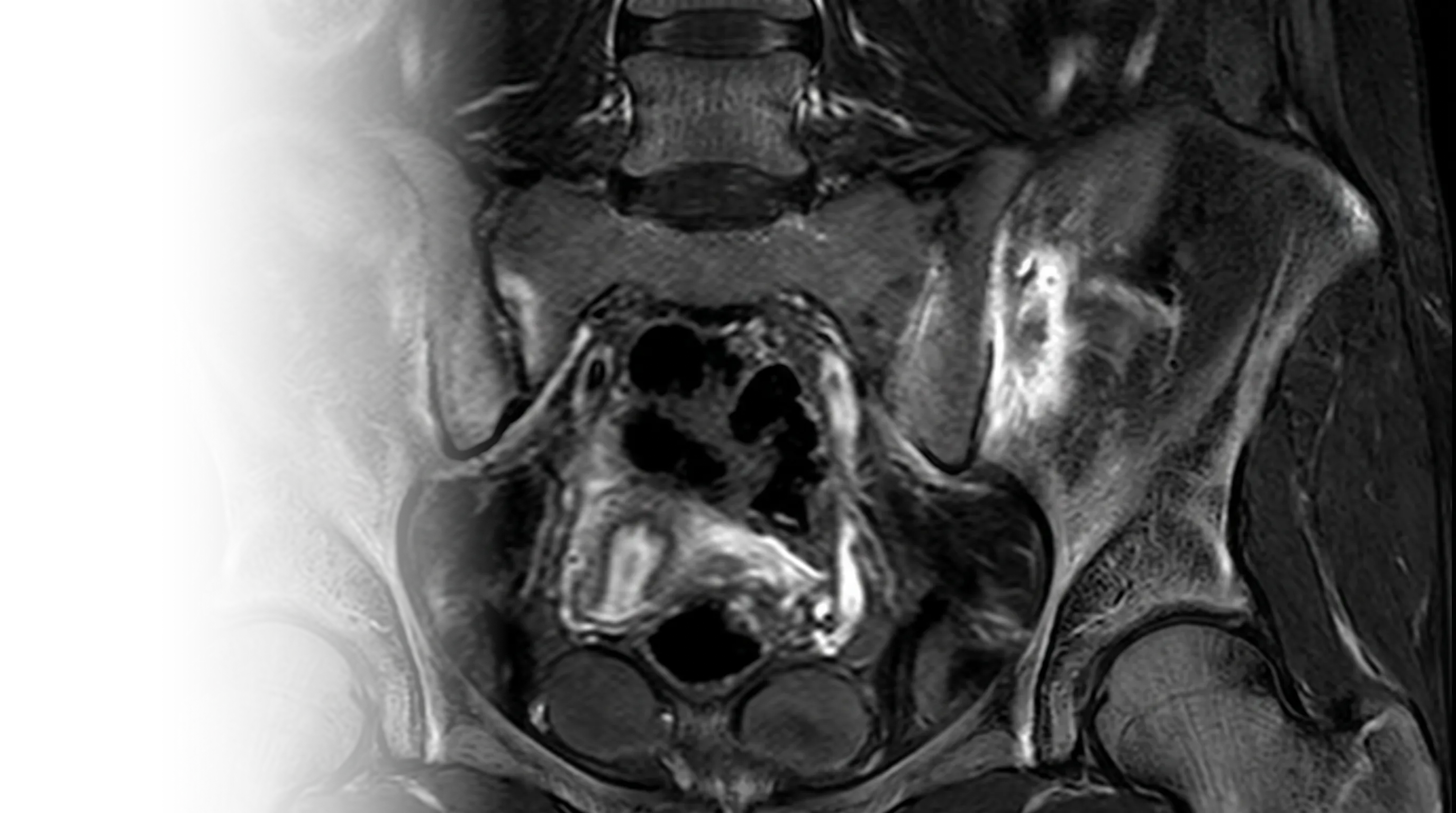 МРТ крестцово-подвздошных сочленений